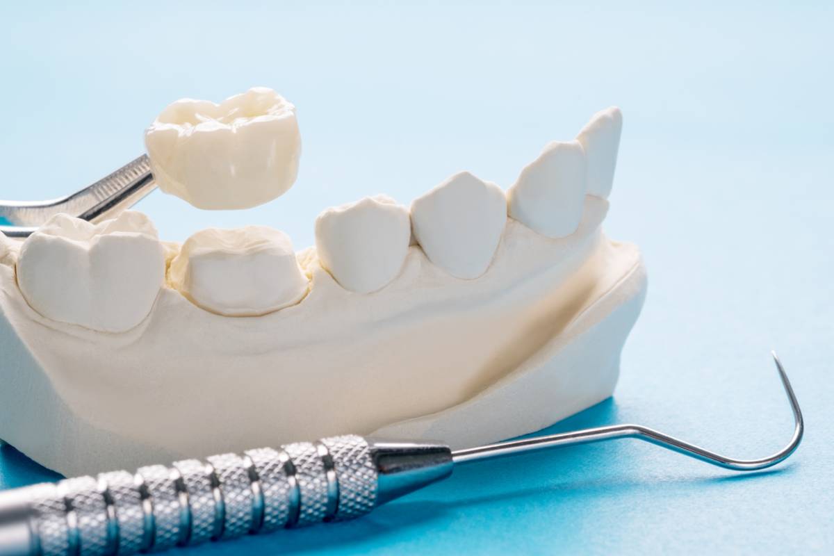 featured image for signs you need to replace a dental implant crown