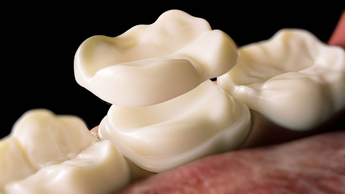 featured image for can dental crowns get decay