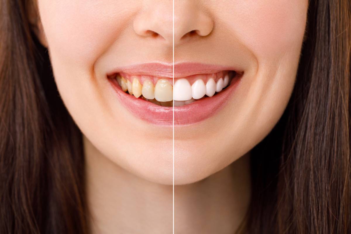 concept of teeth whitening and enamel after treatment