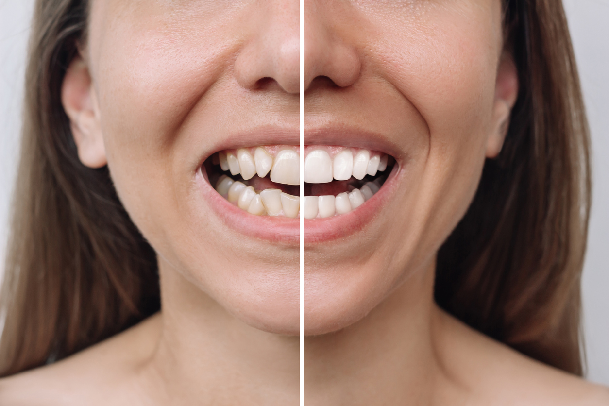 Cropped image of a young woman before and after veneers to represent how they can change the way you are perceived.