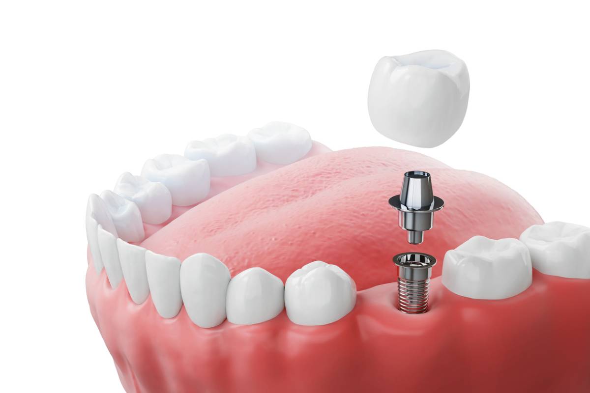 concept for how long does it take to insert dental implants