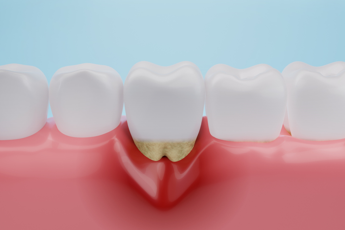 Featured image for Can Periodontitis Be Cured?